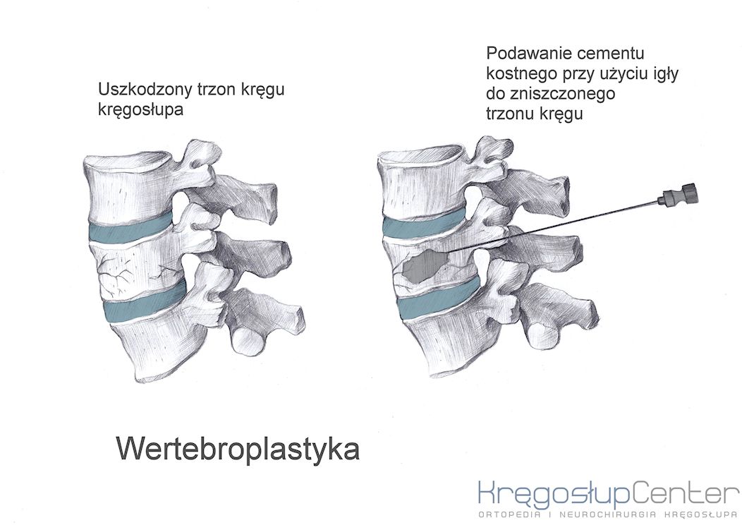 wertebroplastyka